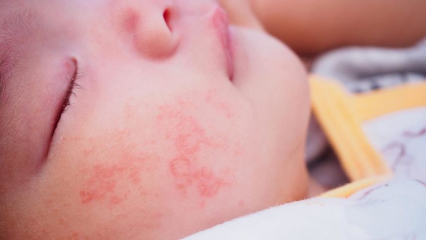 When to Get an Allergy Test For Your Child